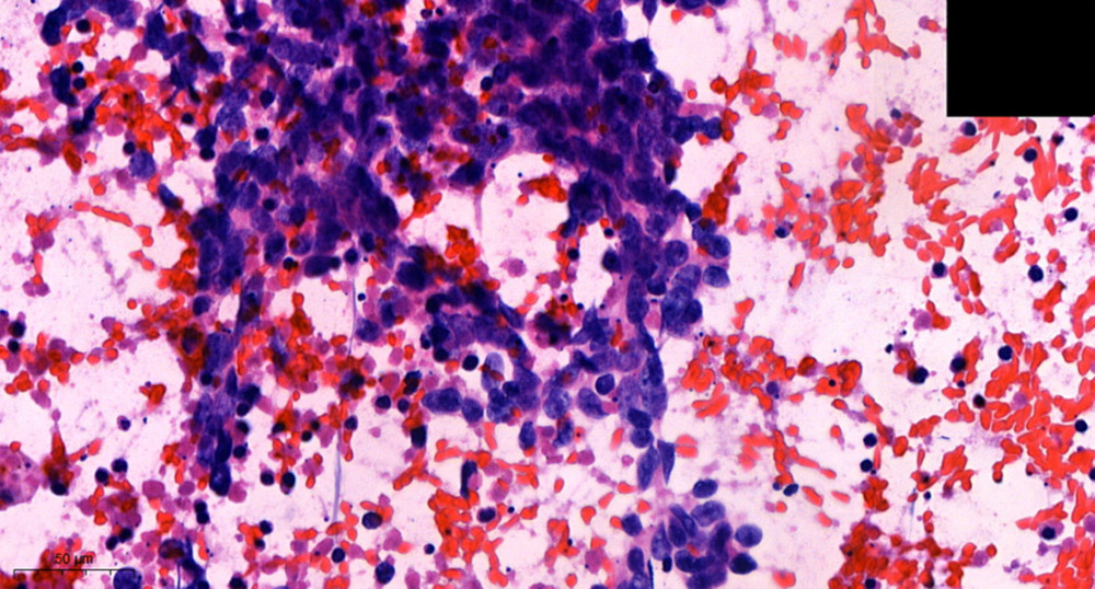 Cytology of the material obtained by bronchoscopy, resulting in small cell lung cancer diagnosis.