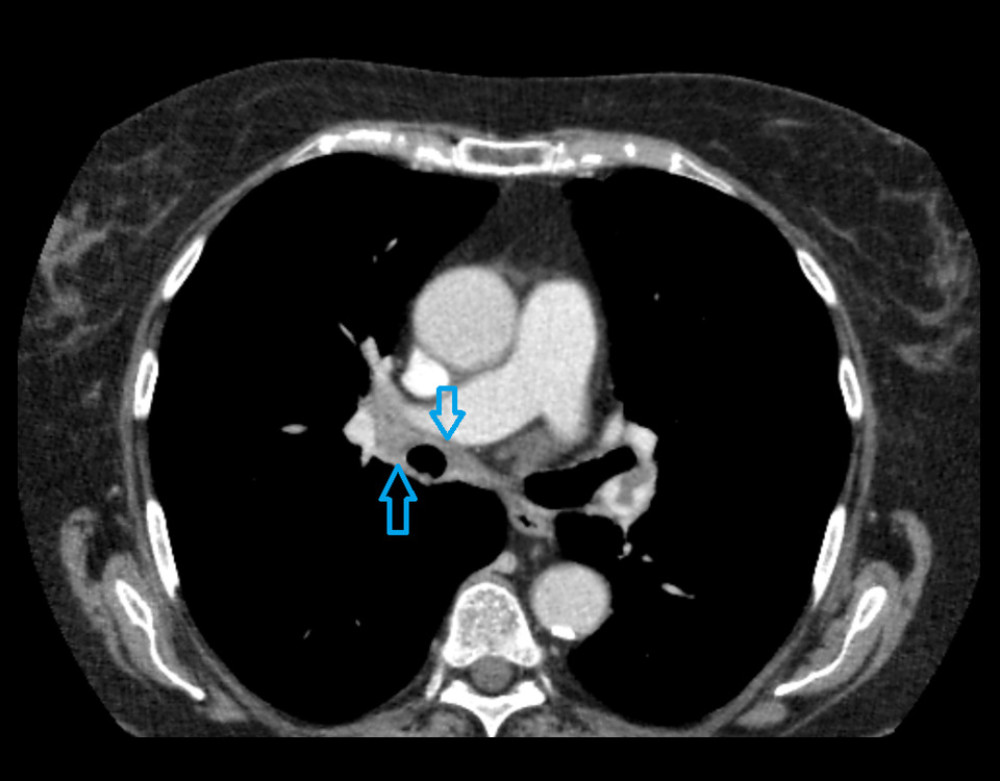 Computed tomography scan of the chest with contrast agent (after fourth cycle of first-line treatment) showing irregular outline and streaked densities around the right main bronchus approximately 7 mm wide (blue arrows).