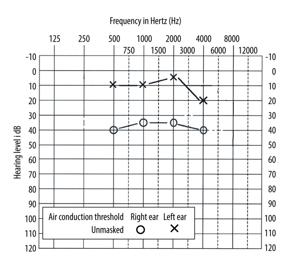 The pure tone audiometry (PTA) of the right and left ear. Y-axis is the hearing thresholds (dB) and the x-axis is the tested frequencies (Hz).