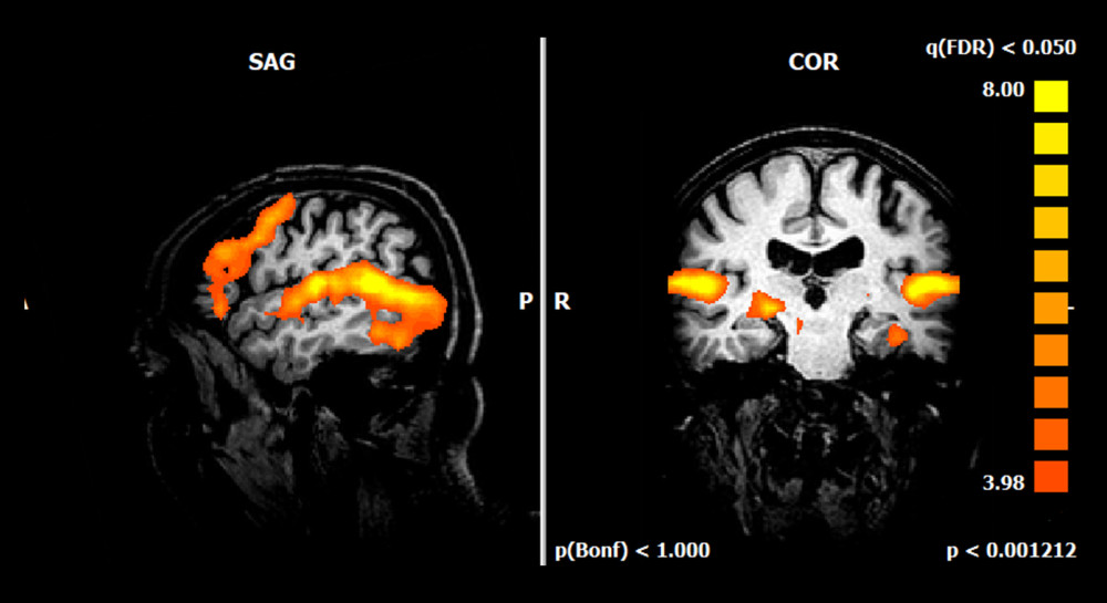 FMRI analyses of a MH case. Significant increased activation in the superior temporal gyrus, cingulate gyrus, and inferior frontal gyrus. Extent of activation was measured by number of voxels, which was thresholded at ≥100 contagious voxels at p value corrected applying false discovery rate (pFDR) <0.05. R – right; P – posterior; COR – coronal; SAG – sagittal.