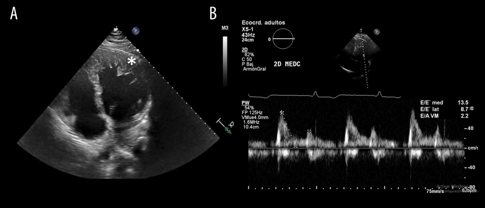 Transthoracic echocardiogram 2 years prior to admission. (A) Four-chamber view showing left ventricular apical segments with hyper-trabeculation (white asterisk). (B) Trans-mitral flow velocity revealed a restrictive pattern (E/A >2).