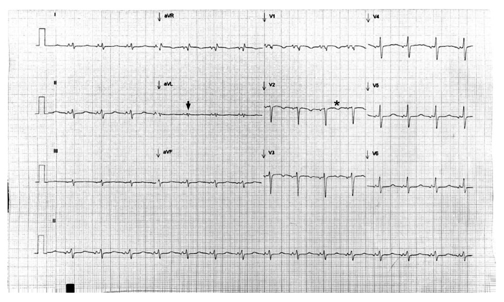 Electrocardiogram upon patient’s admission. Electrocardiogram exhibiting sinus rhythm with low voltage QRS complexes in limb leads (black arrowhead), shortened PR interval (80 ms), and negative T waves in precordial leads (black asterisk).