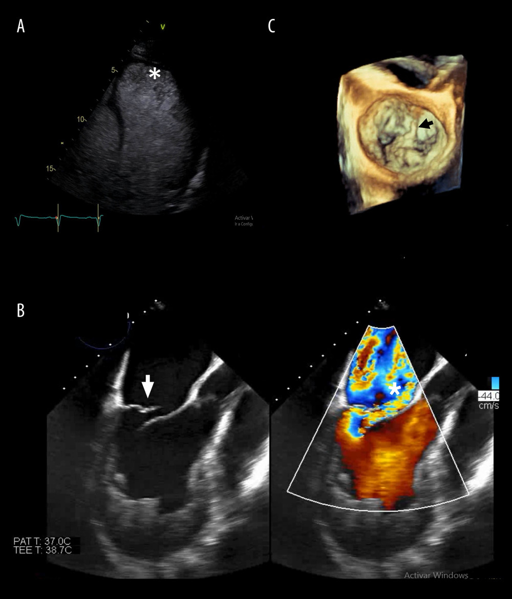Echocardiographic findings upon patient’s admission. (A) Contrast echocardiography in a 4-chamber view showing apical left ventricular hyper-trabeculation (white asterisk). (B) Transesophageal echocardiography 3-chamber view demonstrating P2 mitral valve leaflet flail (white arrowhead) causing significant regurgitation (white asterisk). (C) 3D mitral valve reconstruction showing P2 segment flail (black arrowhead).