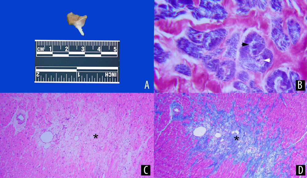 Cardiac tissue biopsy with chronic ischemic cardiomyopathy changes. (A) Gross pathology of the heart biopsy specimen. (B) Coagulative myocytolysis with contraction bands (black arrowhead) and pyknotic nuclei (white arrowhead) (phosphotungstic acid-hematoxylin; ×250). (C) Chronic ischemic cardiomyopathy with myocardiocytes disarray, fibrosis (black asterisk) (hematoxylin and eosin ×100) and (D) collagen deposits revealed with Masson’s trichrome (black asterisk).