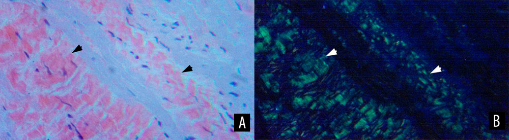 Congo red staining and polarized light positivity suggested cardiac amyloidosis. (A) Heart biopsy slide stained with Congo red showing amorphous cytoplasmic aggregates (black arrowheads) and (B) anomalous green color revealed using polarized light (white arrowhead) (×100).