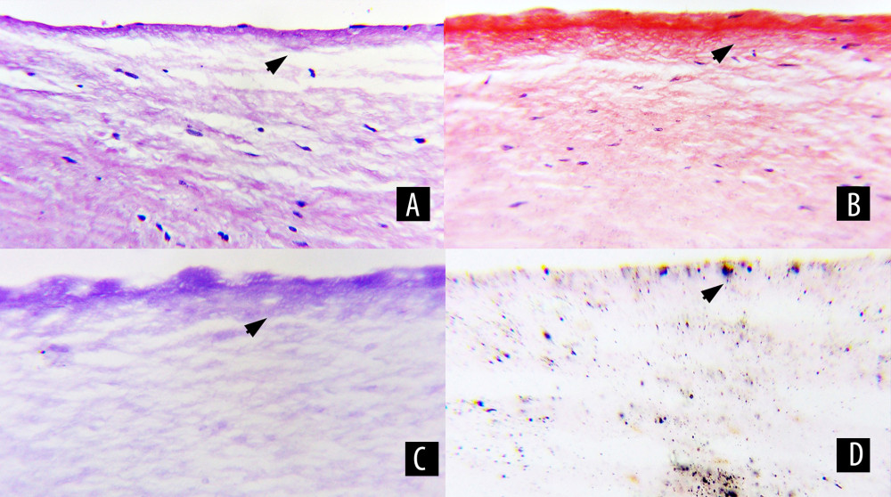 Native mitral valve showing Congo red positive deposits. (A) Subendocardial and spongiosa stroma with mild thickening (black arrowhead) (hematoxylin and eosin ×250). (B, C) Laminar and linear positive staining pattern in the subendothelial stroma (black arrowheads) (Congo red and crystal violet, ×100 and ×250]. (D) Granular calcium pattern in the cytoplasm of endothelial and stromal cells (black arrowhead) (Von Kossa; ×100 and ×250).