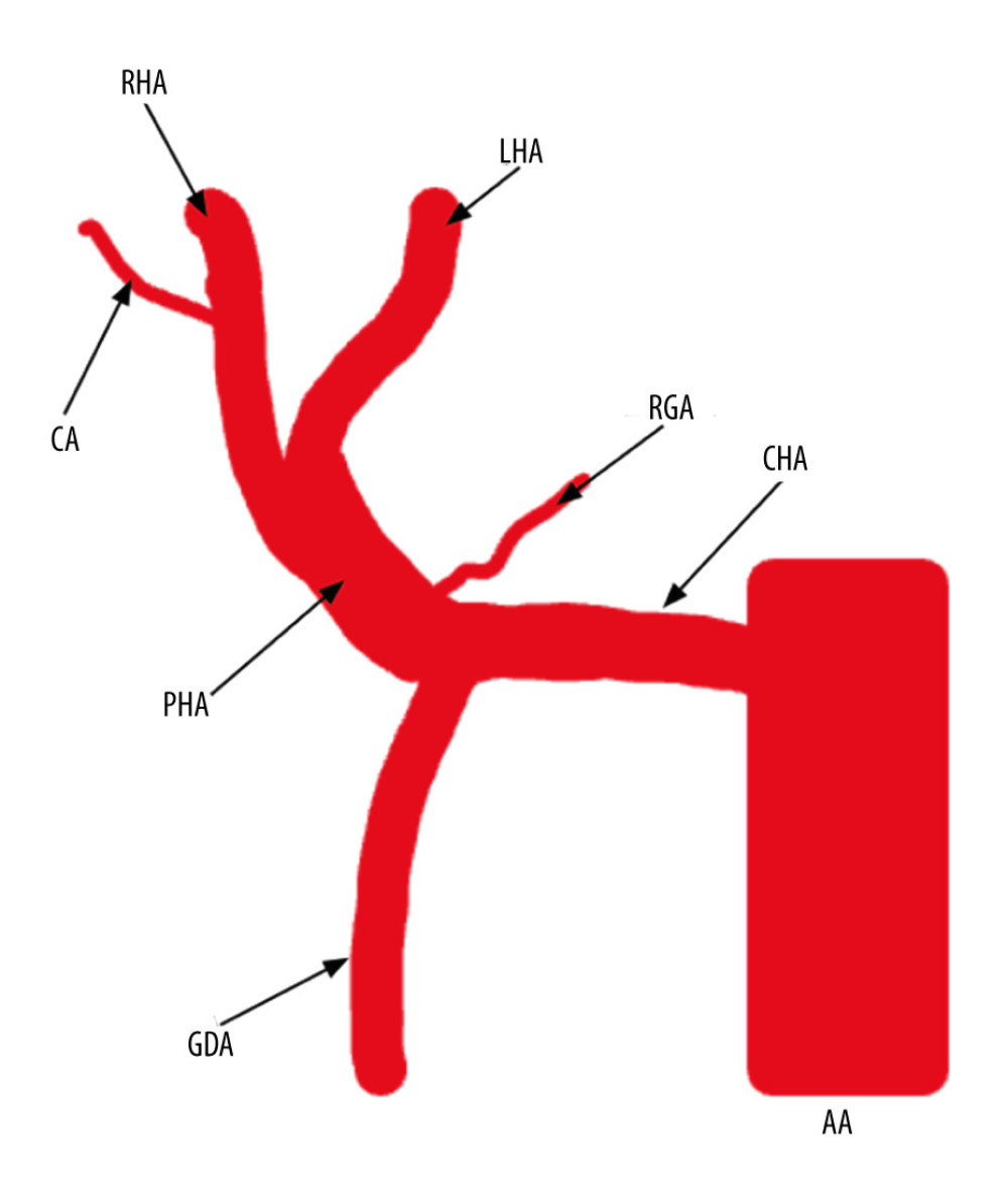 The typical vasculature of the common hepatic artery based on Gray’s Anatomy description [3].