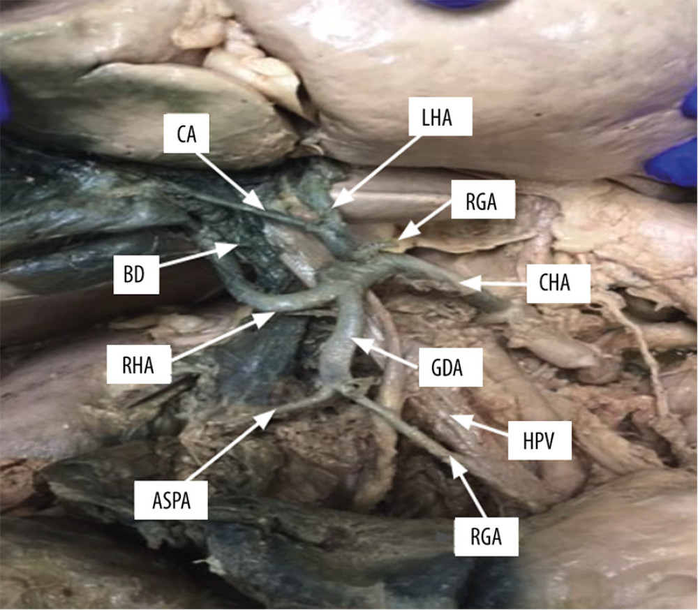 The left hepatic artery can be seen branching from the common hepatic artery, which continues to further branch into the right hepatic artery and gastroduodenal artery.