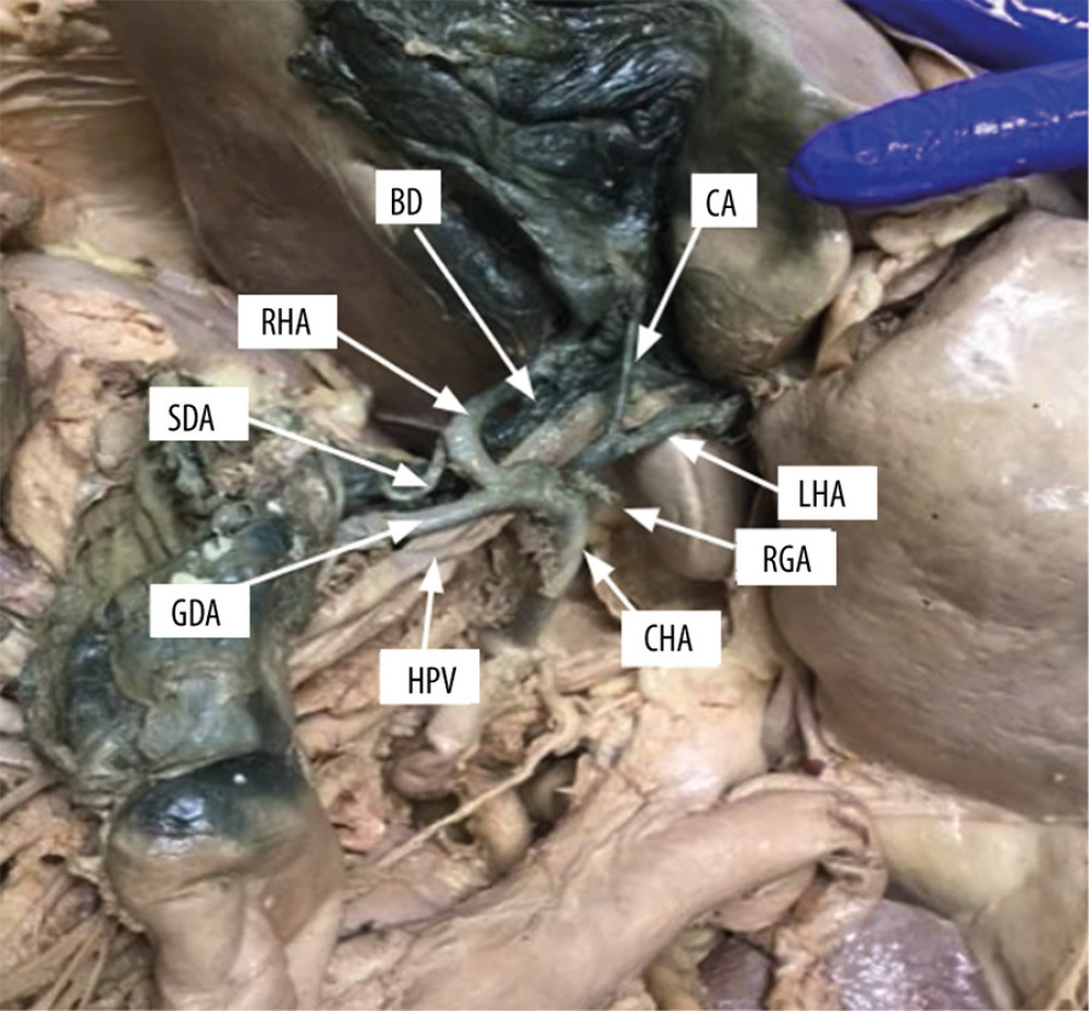 0Here is a second view if the vascular abnormality. Also of note is the cystic artery branching off the left hepatic artery, traveling anteriorly over the bile duct and portal vein.