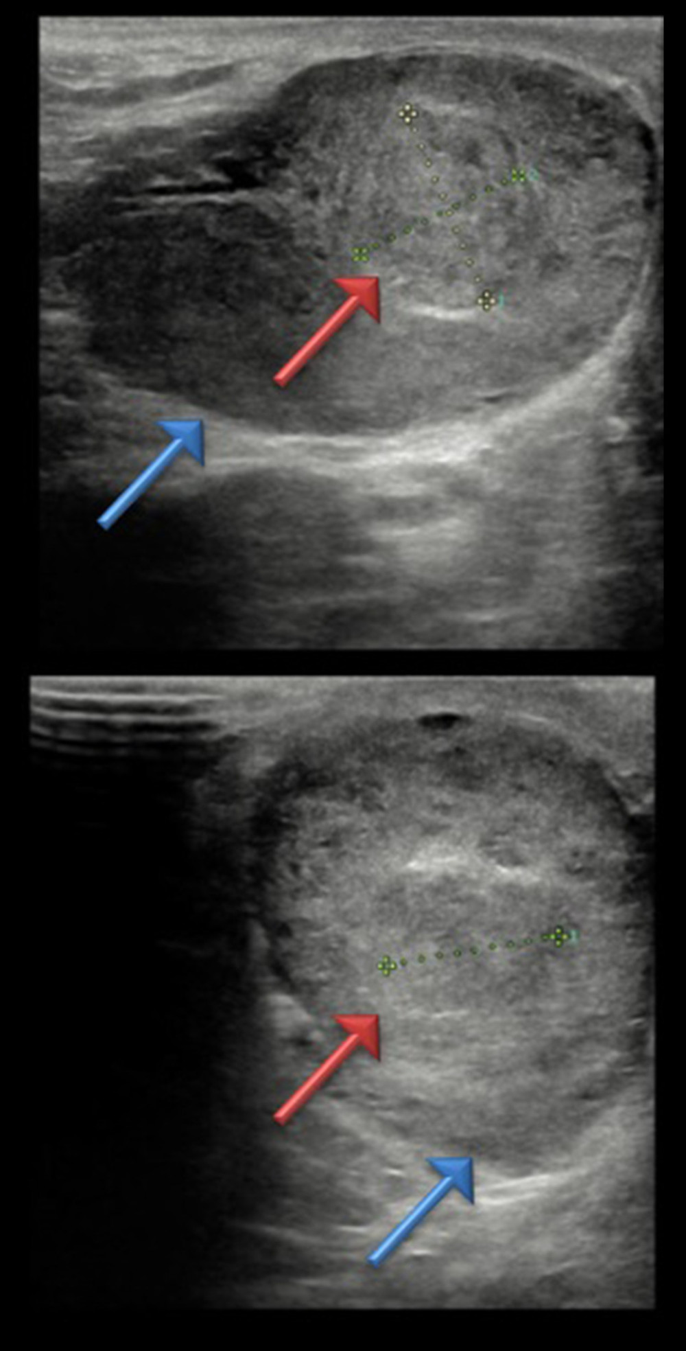 Ultrasound of the right testis. The image shows the solid lesion of 1.38×1.39×1.60 cm (red arrows) in the right testis (blue arrows) of 7 cm, indiscernible among the primary or secondary tumor (image is in 1: 1 scale).