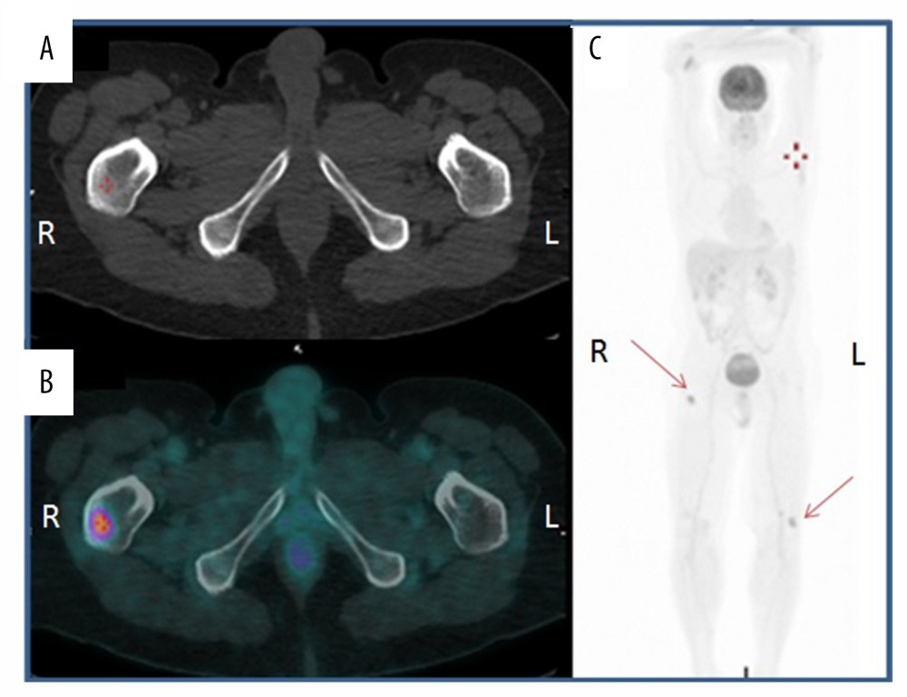 18FDG-PET/CT after the right orchiectomy. The figures on the left show the CT scan screenshot of the lower pelvis (A) with a lesion on the right thighbone (red cross) and (B) the FDG uptake on the same site in the PET/CT scan screenshot (red cross). (C) On the left, the image shows the whole-body screenshot with the FDG uptake in the right thighbone metastasis (red arrows). R – right; L – left.