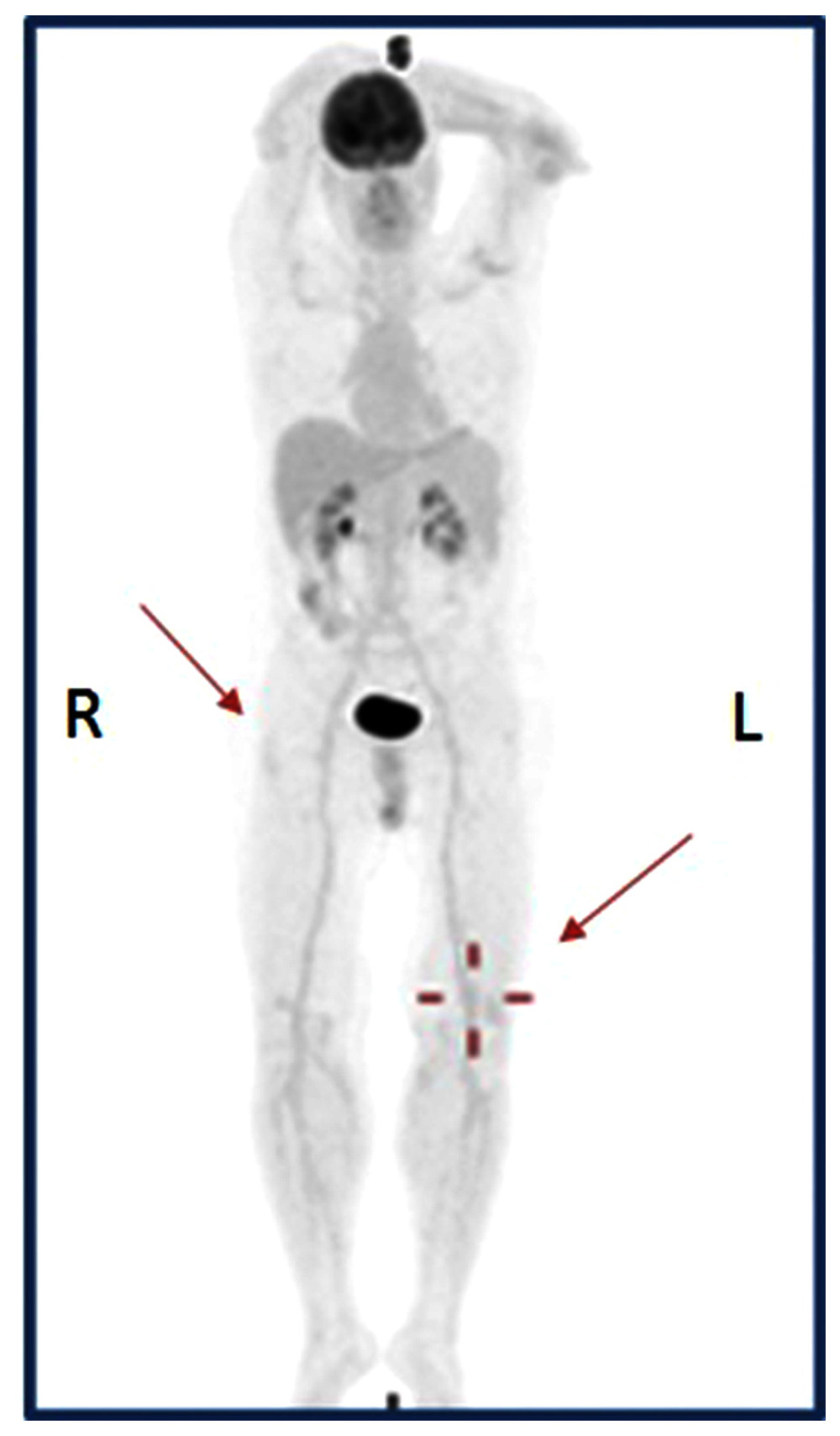 18FDG-PET/CT after immunotherapy: the complete functional response. The scan of 18FDG-PET/CT performed after 3 months of immunotherapy start shows a functional complete response of all previous metastatic lesions; in particular, the previous thighbones metastases are now undetectable (red arrows). R – right, L – left.