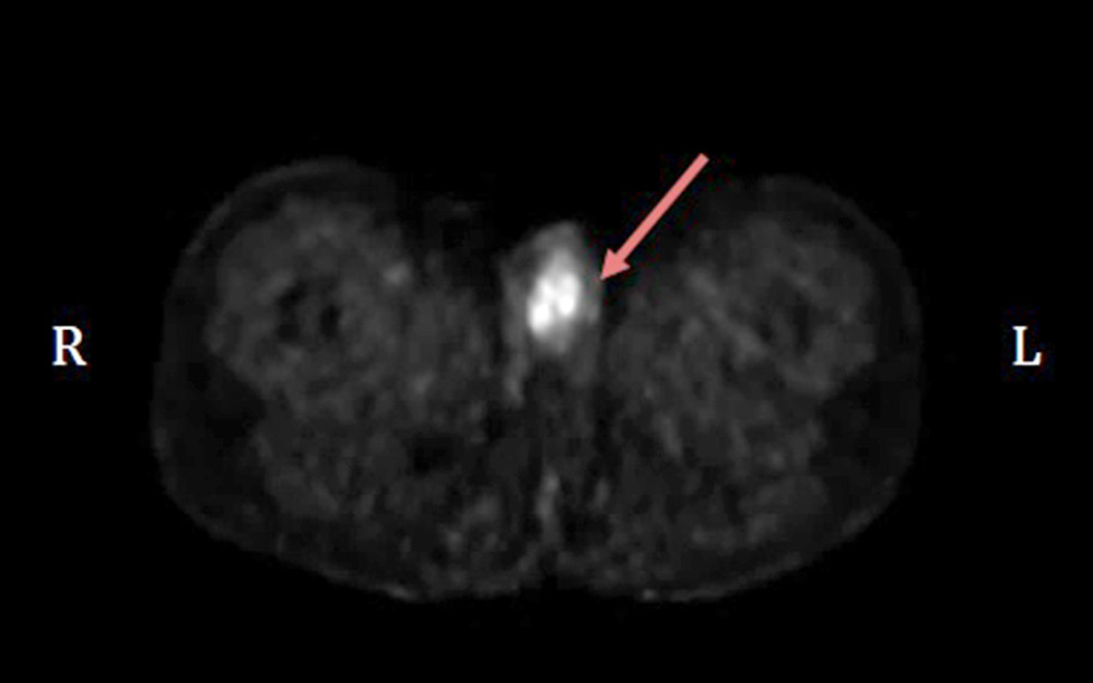 18FDG-PET/CT scan of the limb and testes. The image shows the screenshot of a 18FDG-PET/CT scan performed 10 months from the start of immunotherapy. The red arrow indicates the appearance of the new FDG uptake on the right testis, consistent with the new testis metastasis. R – right, L – left.