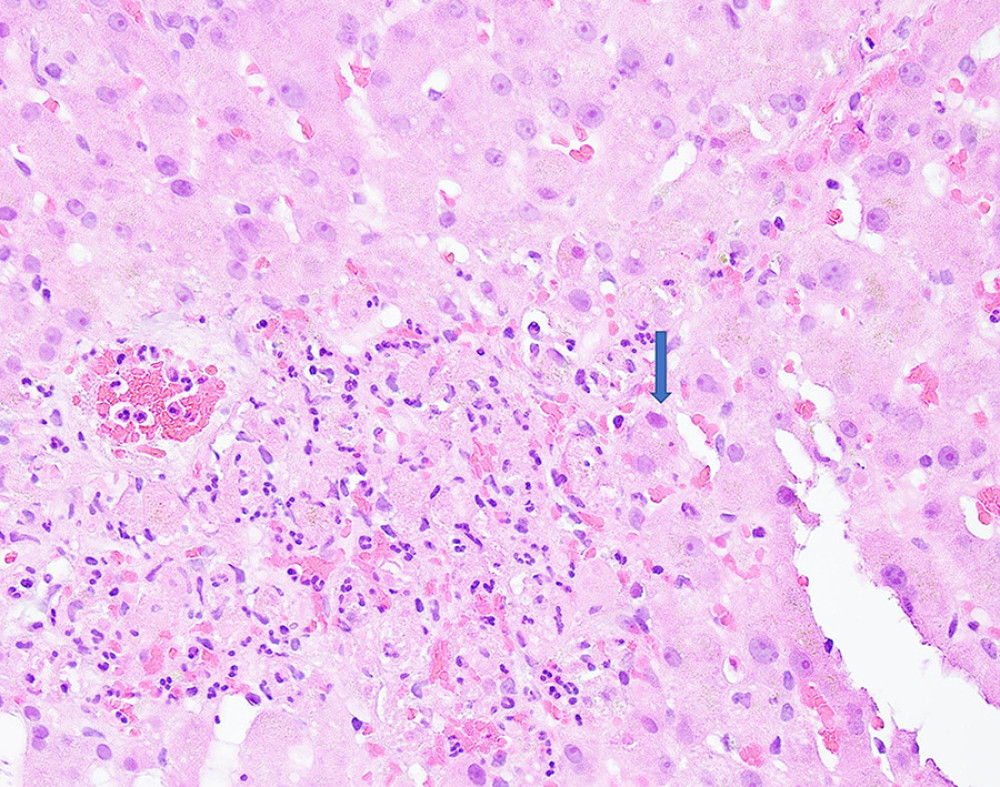 Adenovirus hepatitis. High-power view of the liver biopsy shows a focus of neutrophilic inflammatory infiltrate with necrotic hepatocytes. The adjacent viable hepatocytes demonstrate large and basophilic smudgy nuclei-adenovirus inclusion (arrow, ×600).