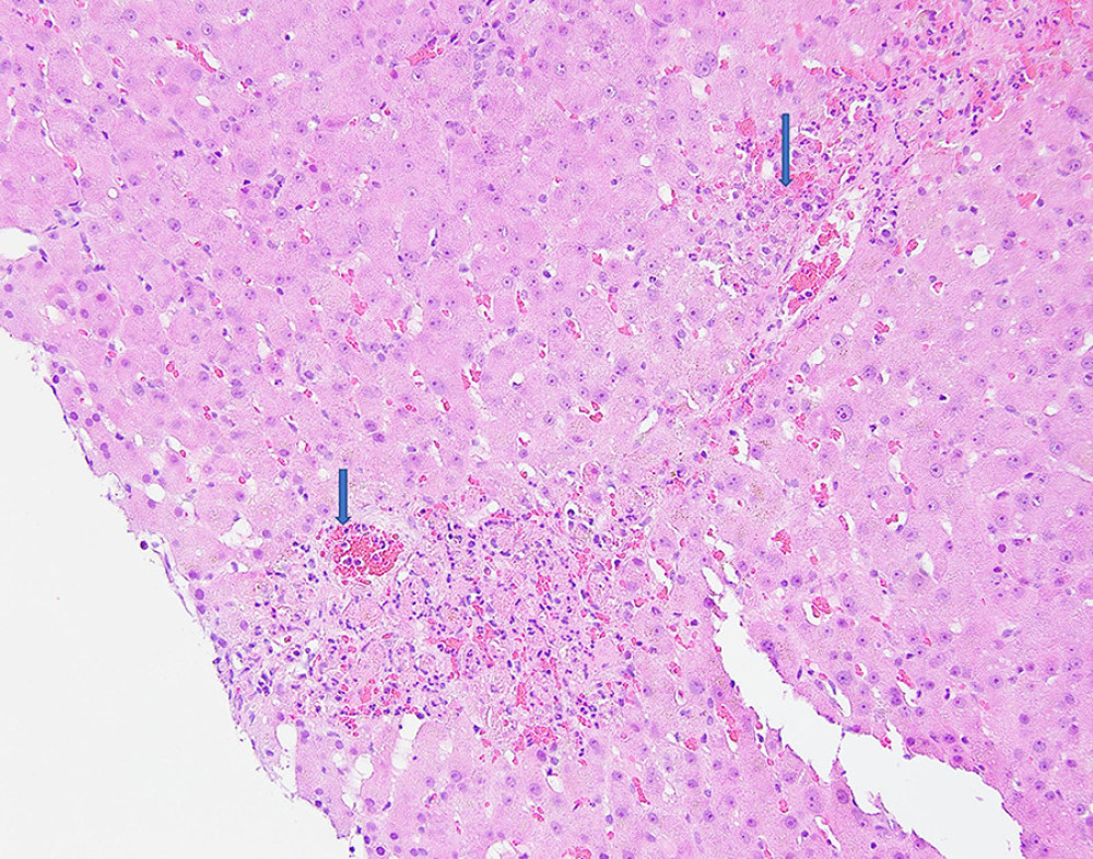 Adenovirus hepatitis: Low-power view of the liver biopsy shows extensive hepatic necrosis.