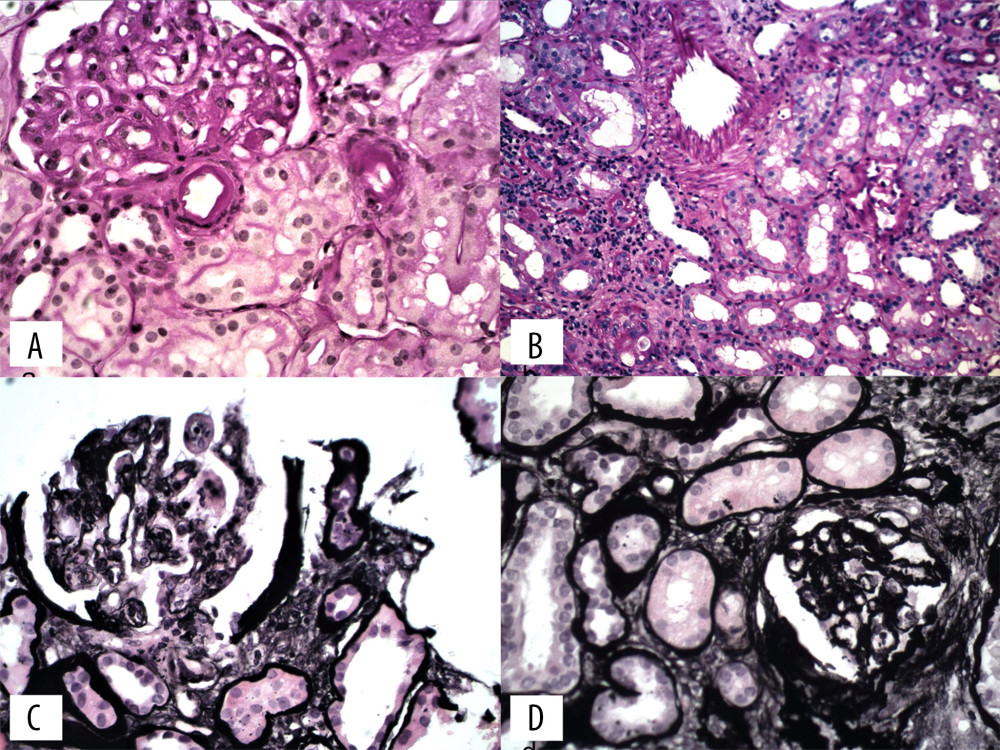 (A) Thickened capillary walls, expansion of mesangial matrix; double contouring of the glomerular capillary walls, hyalinization of arterioles [PAS stain]; (B) Sclerotization of the inner membranes of the arterioles; inflammatory infiltration of lymphocytes in the interstitium. [PAS stain]; (C) Thickened capillary walls, segmental sclerotization of capillary loops [Jones silver stain]; (D) Shrinkage of the vascular tufts of the glomeruli coexisting with wrinkling of the capillary contouring (chronic ischemic changes) [Jones silver stain]. Courtesy of Professor Małgorzata Wągrowska-Danilewicz, Department of Nephropathology, Medical University of Łódź, Poland.