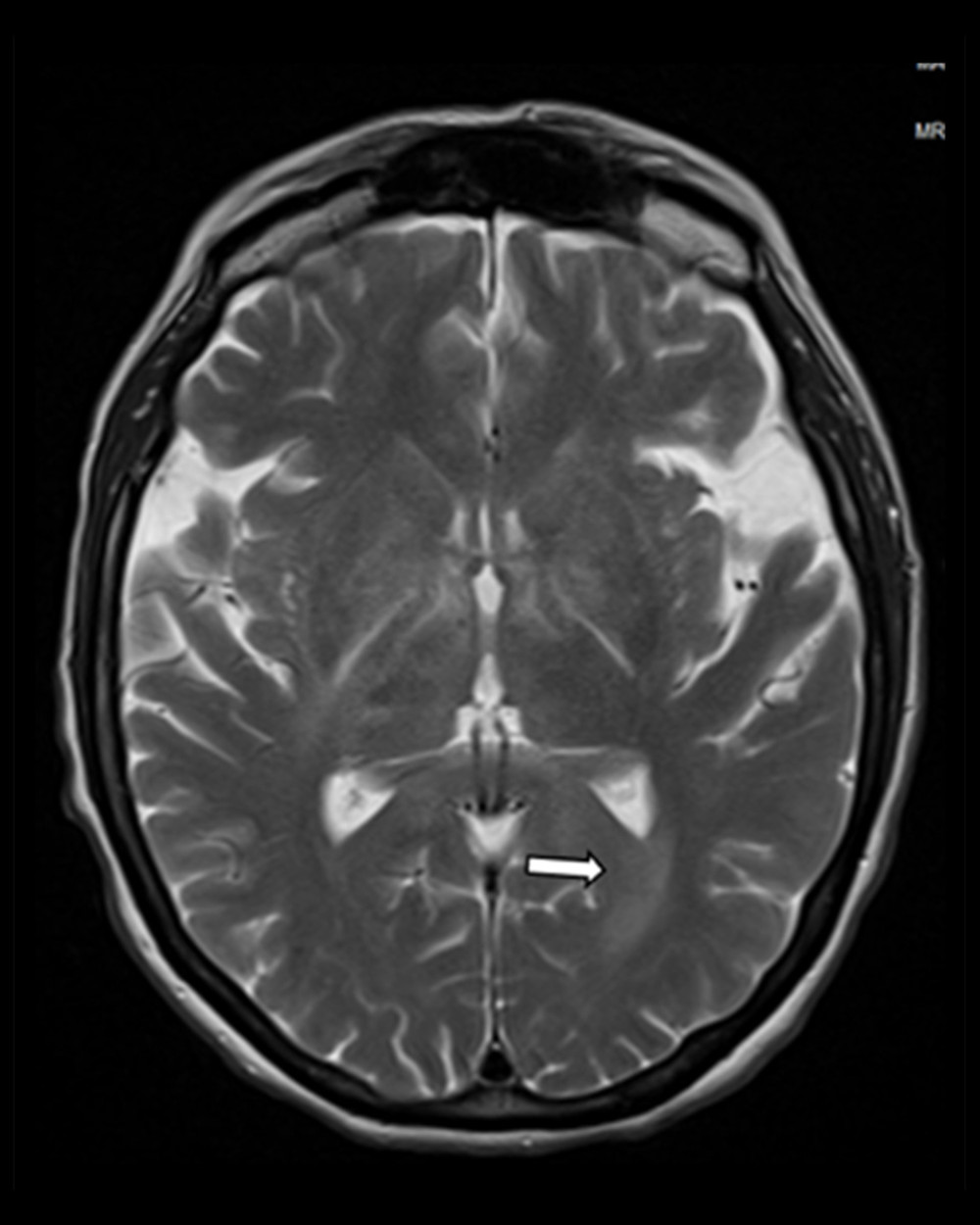 MRI brain without contrast showing diffuse near symmetric acute leukoencephalopathy process involving the deep white matter.