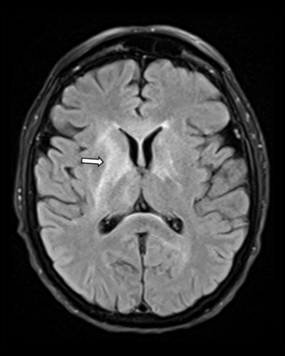 MRI brain with contrast showing diffuse near symmetric acute leukoencephalopathy process involving the deep white matter.