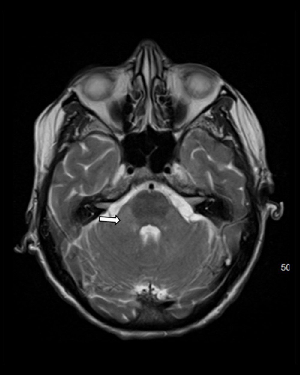 MRI brain without contrast showing diffuse near symmetric acute leukoencephalopathy process involving the deep white matter at the level of the cerebellum.
