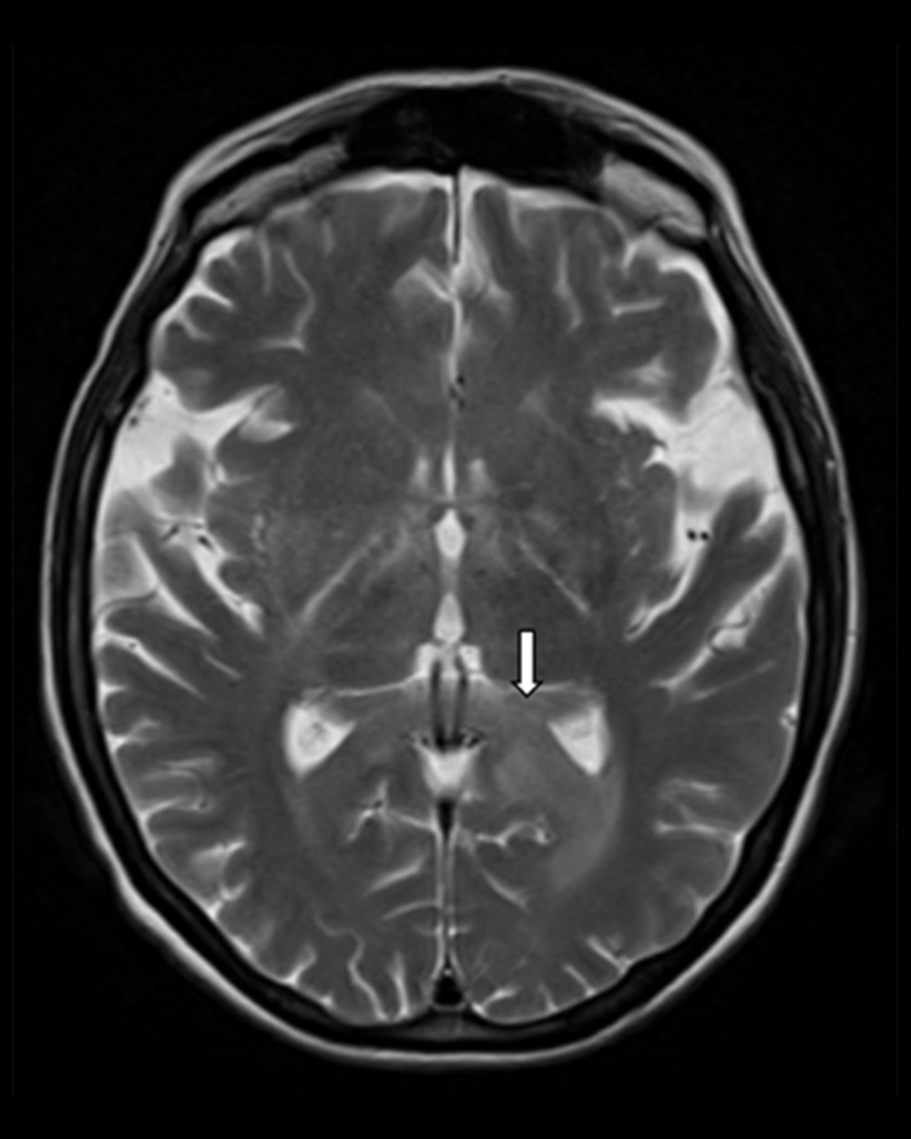 MRI brain 1 month after patient’s initial presentation, with stable findings.