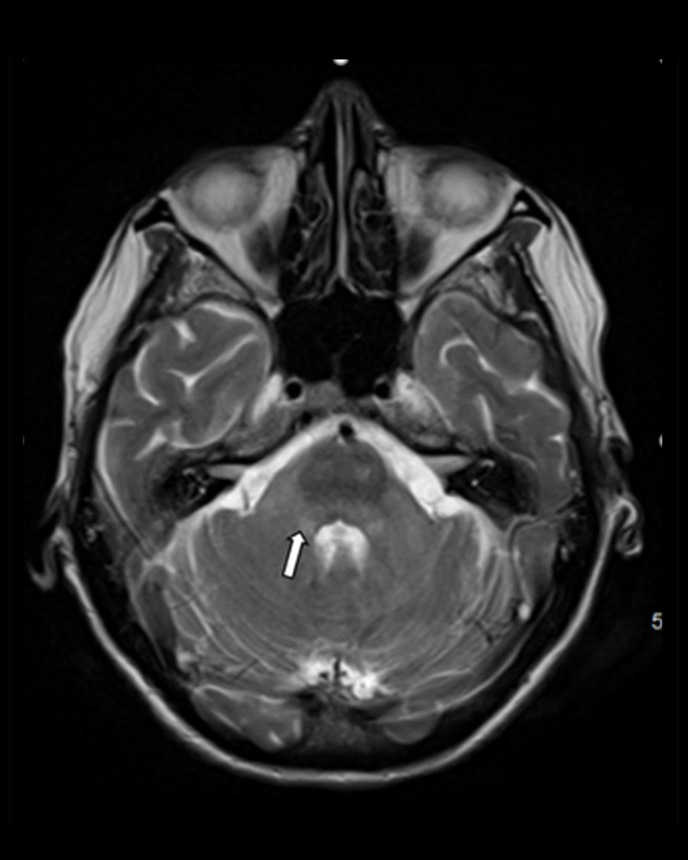 MRI brain 1 month after patient’s initial presentation, with stable findings at the level of the cerebellum.