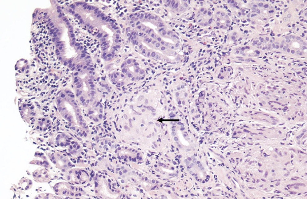 Gastric oxyntic-type mucosa, notable for the presence of noncaseating granulomas (black arrow) in the lamina propria. These granulomas are well formed, and consist of epithelioid cells and giant cells. There is a background of focally active chronic gastritis (H. pylori-negative by immunohistochemistry), and reactive epithelial changes.