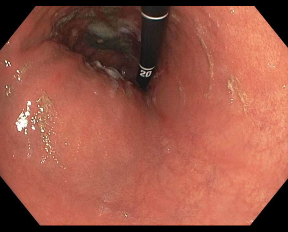 Gastric body with focal erosions during endoscopic evaluation.