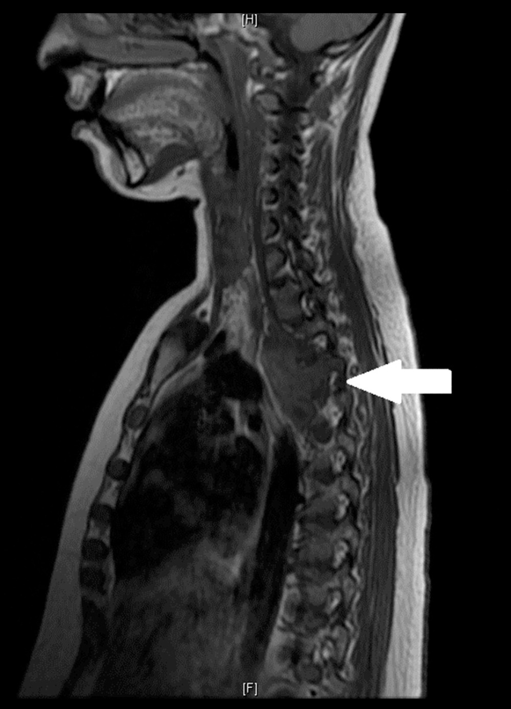 Post-gadolinium contrast T1-weighted diffusion magnetic resonance imaging of spine showing a large soft tissue at the level of T2, T3, and T4 measuring 3.4×5.0×5.4 cm in the transverse, anteroposterior, and craniocaudal dimensions, respectively (white arrow).