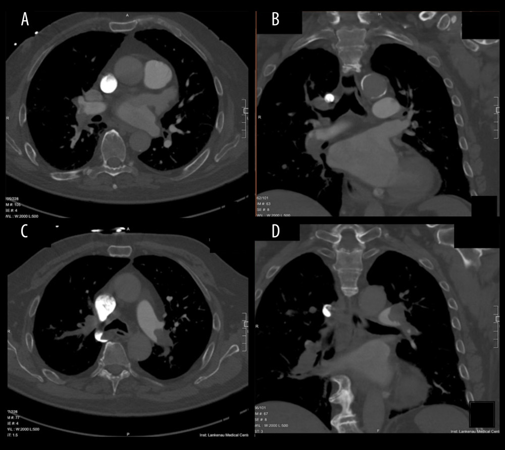 Computed tomography pulmonary angiogram showing extensive pulmonary embolism in the right (axial view [A], coronal view [B]) and left (axial view [C], coronal view [D]) pulmonary vasculature.