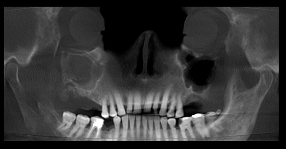 Reconstructed panoramic cone-beam computed tomography (CBCT) image. Reconstructed panoramic CBCT image showing opacification of the right maxillary sinus, destruction of the right maxillary sinus walls, and maxillary tuberosity and sequestration.
