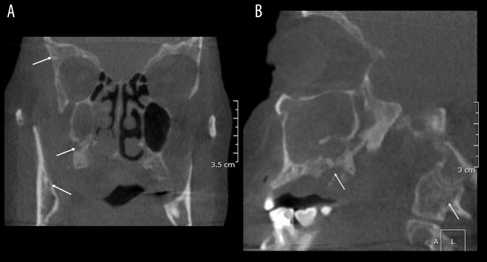 Coronal and sagittal CBCT images. Coronal (A), and sagittal (B) CBCT images showing diffuse osteolytic lesions in the skull (A), cervical vertebrae (B), maxilla (a&b) and mandible (A) as indicated by the arrows.