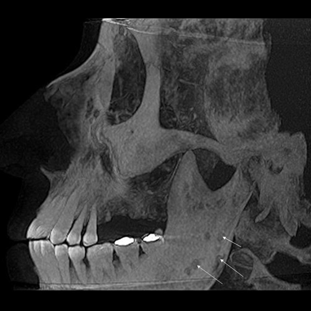 Maximum intensity projection (MIP) CBCT. MIP CBCT image showing multiple, “punched-out”, osteolytic lesions involving the mandible as indicated by the arrows.