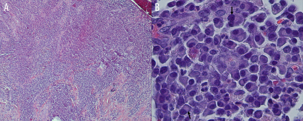 Hematoxylin and eosin (H&E) histopathology slides. (A) H&E staining exhibited multiple areas with sheets of atypical plasma cells (10× magnification). (B) H&E plasma cells with variable sizes showing eccentric nuclei with perinuclear pale zone indicating a “zone of hoff” (bottom arrow) and binucleation of a plasma cell (top arrow) (100× magnification with oil immersion).