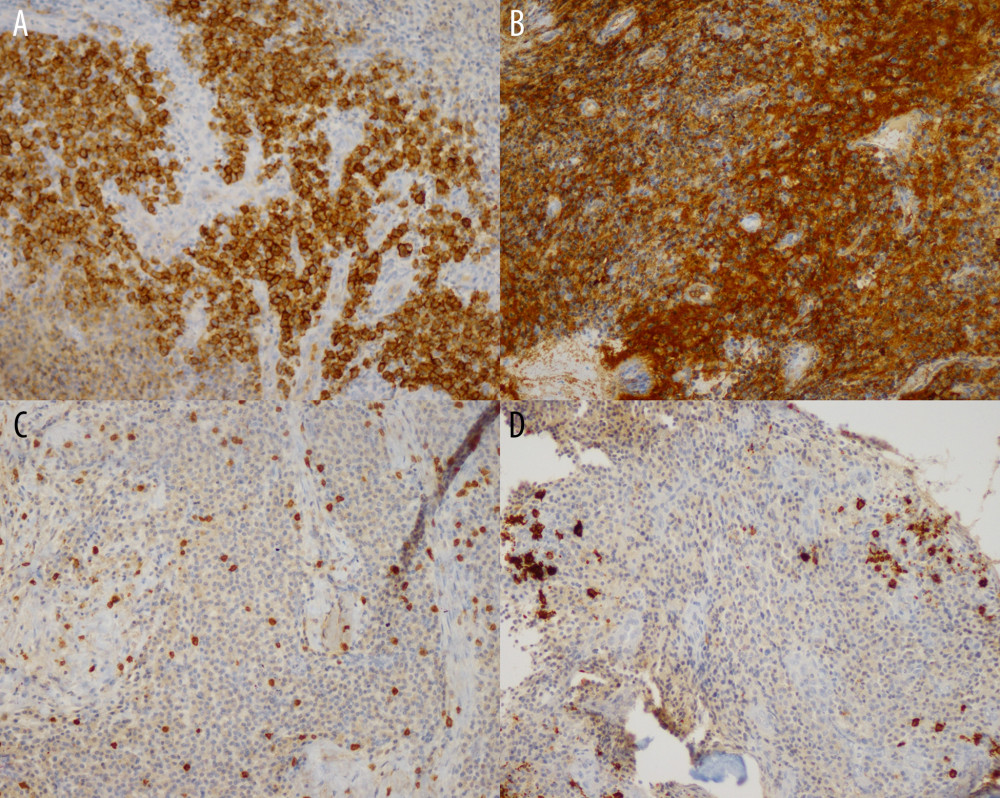 Immunohistochemical stains. (A) Immunohistochemical stains demonstrating CD138 positivity. (B) Immunohistochemical stains demonstrating LAMBDA positivity. (C) Immunohistochemical stains demonstrating CD3 negativity. (D) Immunohistochemical stains demonstrating CD20 negativity.