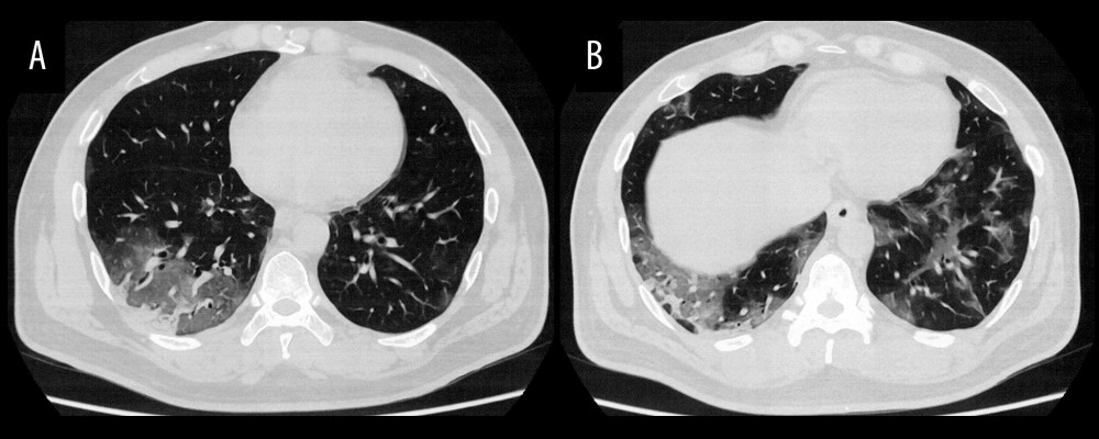 (A, B) Chest computed tomography showing bilateral peripheral ground-glass opacity.