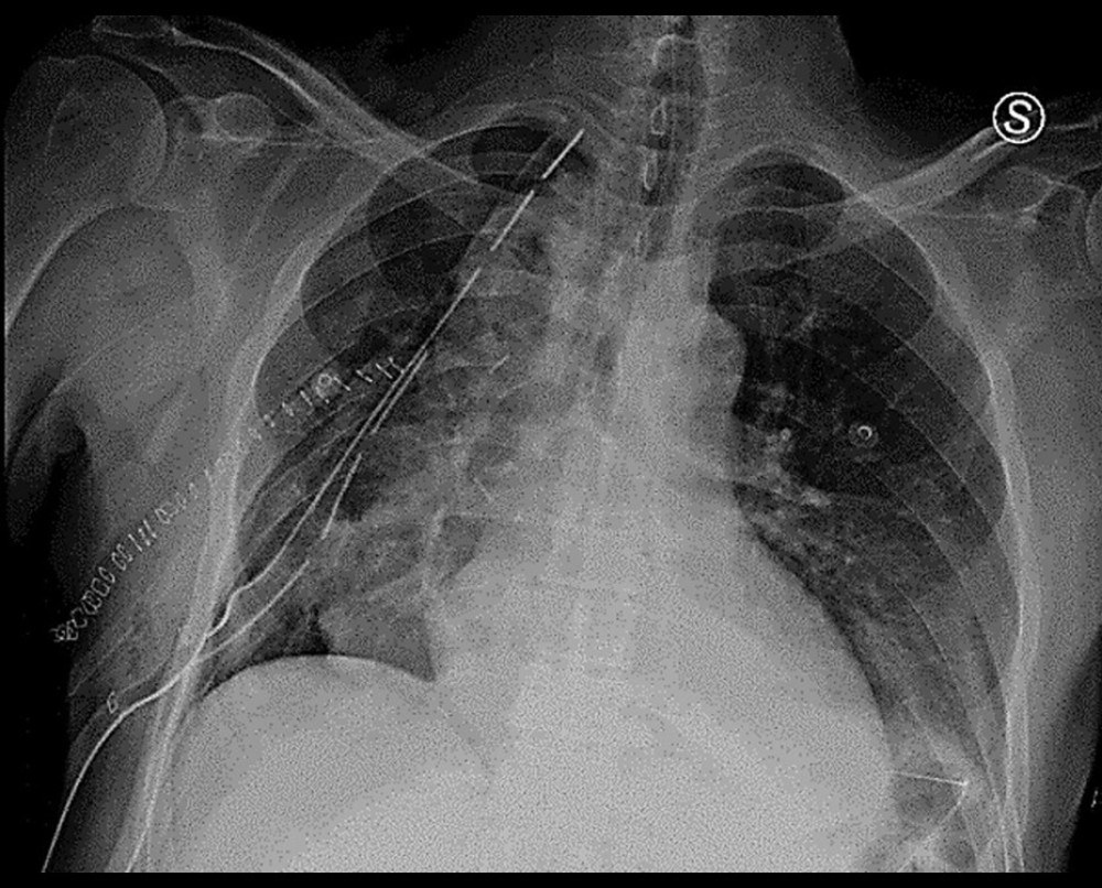 Day 3 postoperative chest X-ray after Ivor-Lewi esophagectomy, showing no sign of consolidation or effusion before apical drain removal.