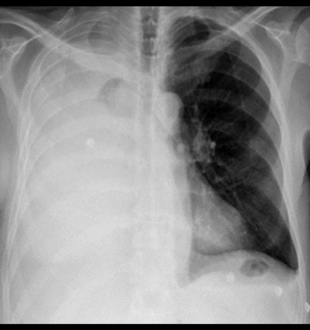 Re-admission chest X-ray 1 month after surgery, showing right unilateral pleural effusion with consensual pulmonary atelectasis.