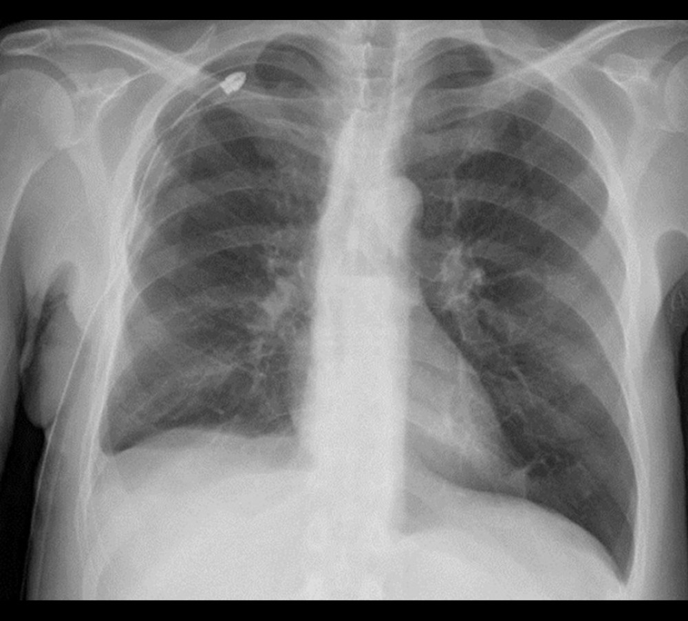 Chest X-ray on day 5 post re-admission after 24-French chest drain inserted showing right lung re-expansion with atelectasis resolution and residual pleural effusion.
