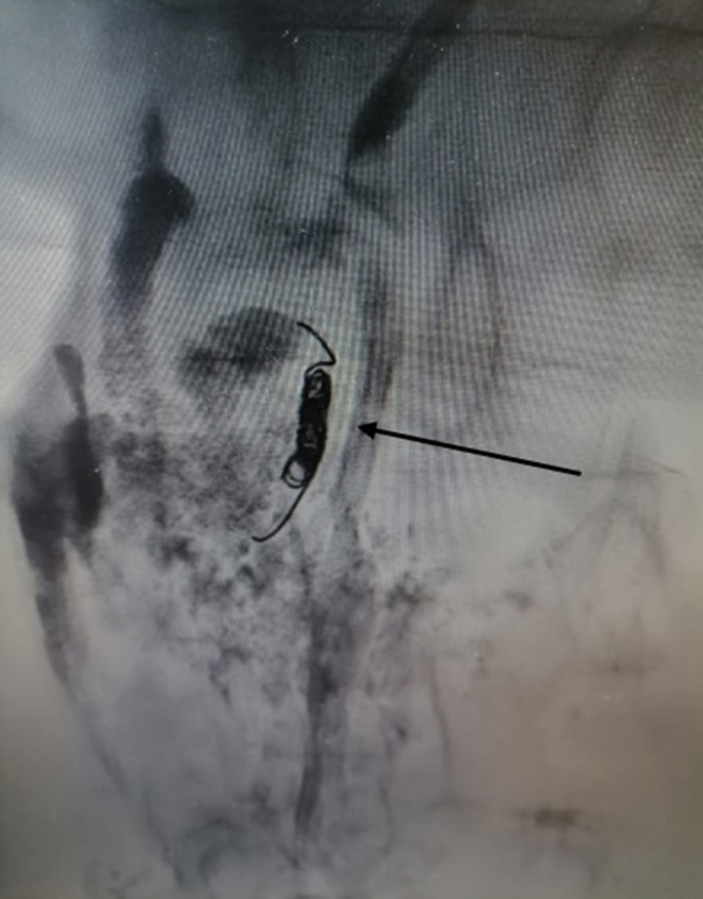 Lymphoscintigraphy images after thoracic duct embolization with 4-mm metallic spiral and glue (arrow) to obtain complete thoracic duct closure.