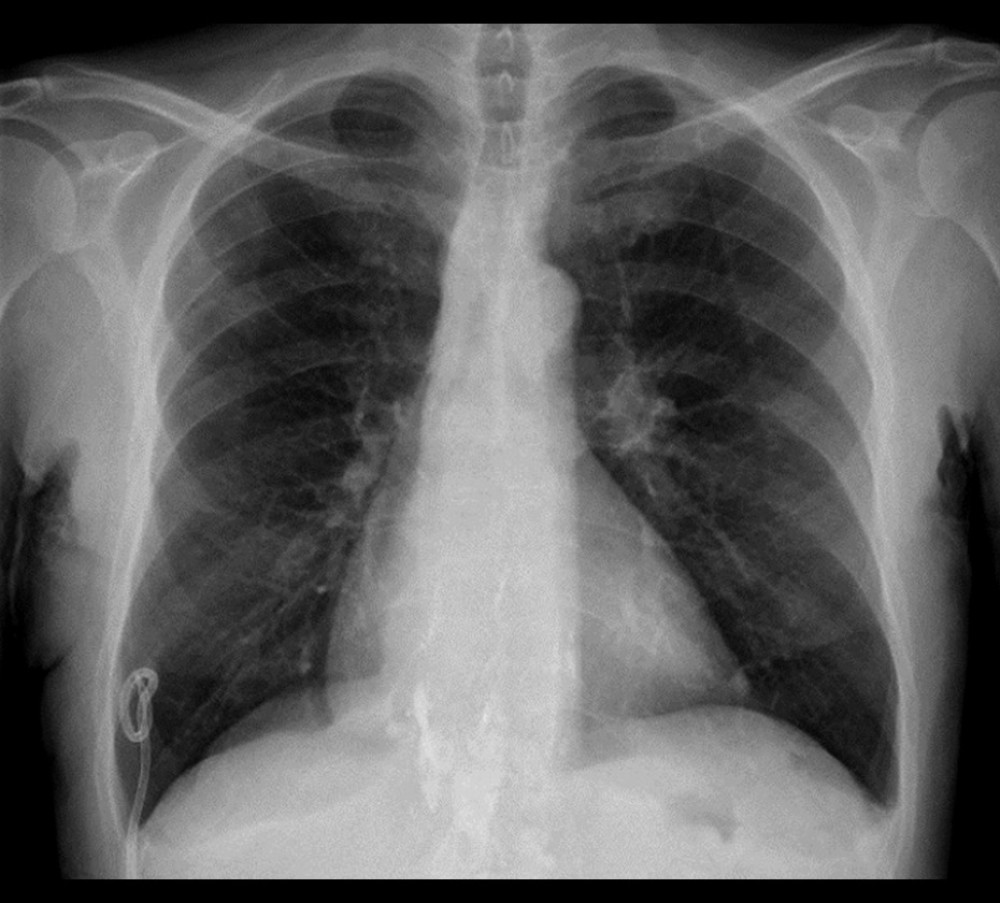 Chest X-ray after discharge showing complete resolution of pleural effusion and complete lung re-expansion.