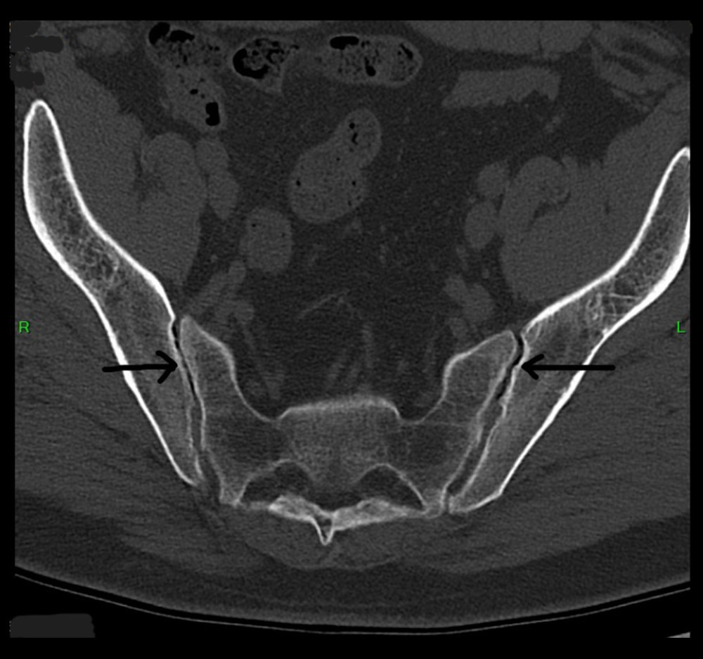Axial view non-contrast CT scan of the pelvis showing bilateral Sacroiliitis and bony erosions (black arrows).