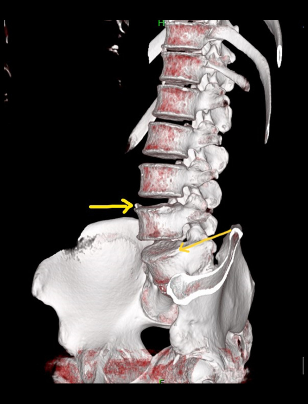 Sagittal view non-contrast CT scan of the lumbar spine using volume rendering technique (VRT) showing syndesmophytes over L4 and L5 vertebrae (yellow arrows).