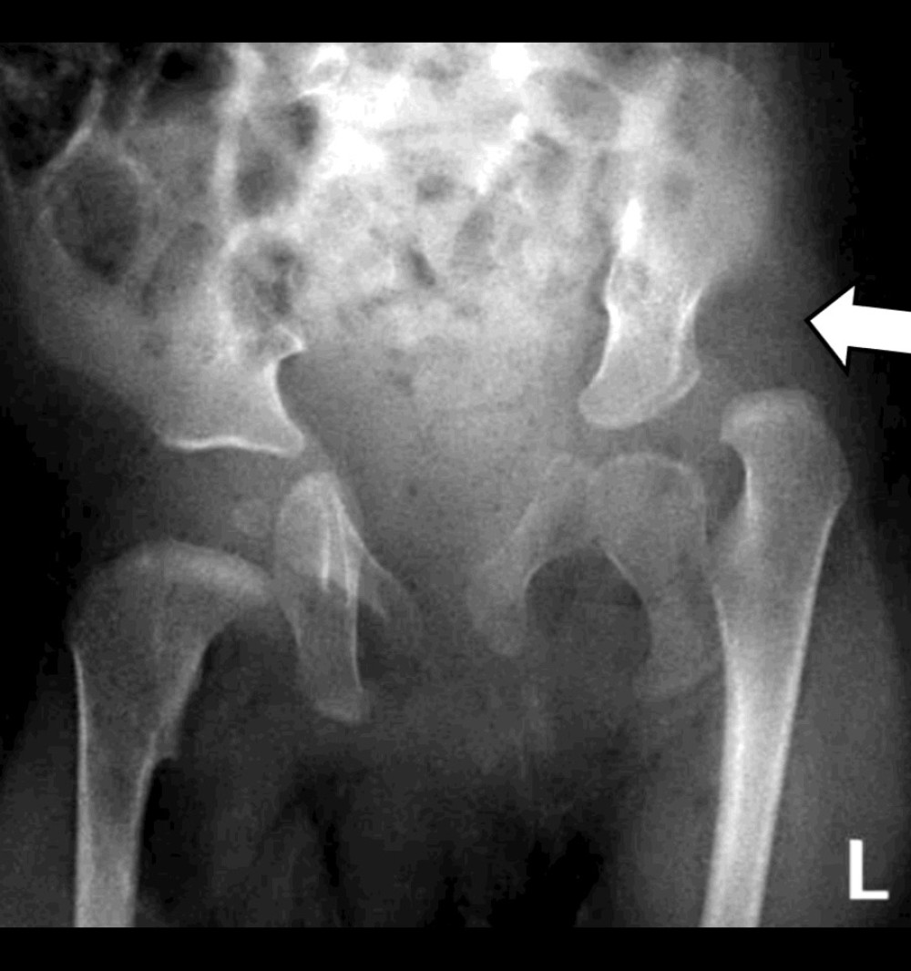 Preoperative plain radiographs of the pelvis, showing left hip dislocation with pseudoacetabulum formation and shallow acetabulum. The arrow indicates the location of the dislocated hip with pseudoacetabulum formation compared with the left normal side.