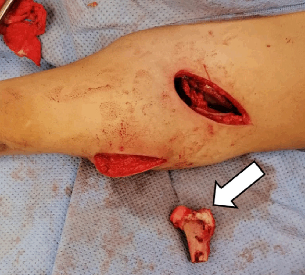 Intra-operative gross picture of extruded bone segment in the sterile surgical field: showing a completely devitalized proximal femur after femoral shortening osteotomy. The arrow shows the extruded bone segment.