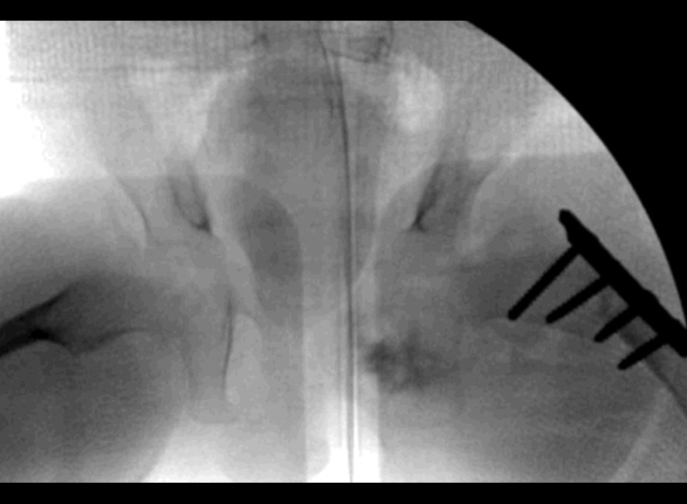 Immediate postoperative plain radiograph of pelvis on hip spica case, demonstrating intraoperative concentric reduction.