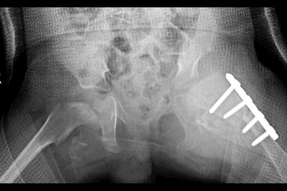 Six weeks postoperative hip X-ray showing the patient with a hip spica, with concentric reduction and healing of the proximal femoral osteotomy site.