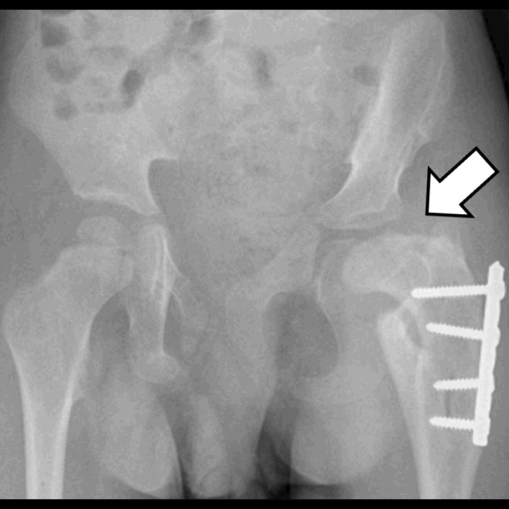 Postoperative plain radiograph of the pelvis 16 months after the operation, showing concentric reduction, femoral head avascular necrosis, and a healed femoral osteotomy site. An arrow demonstrates the absence of an ossific nucleus compared with the normal side, which indicates avascular necrosis of the femoral head.