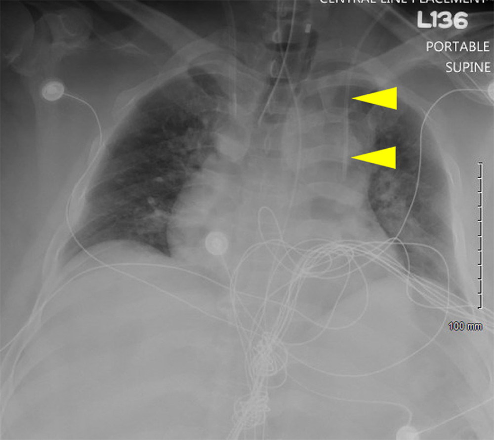 Chest radiography. Chest radiograph confirming placement of the central access line, which did not take its expected course across the midline toward the right atrium.
