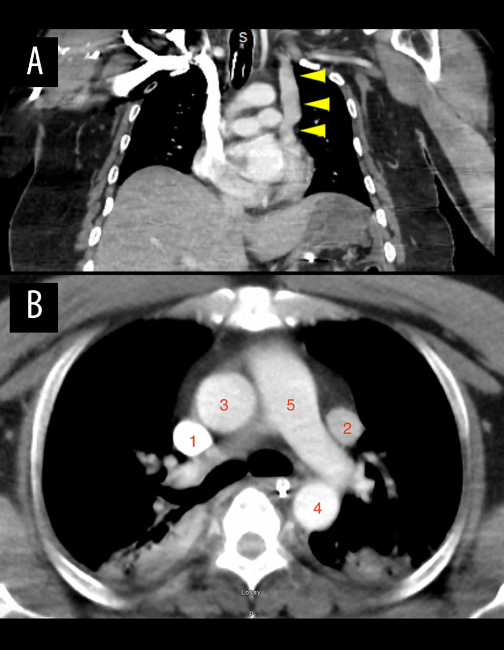 Chest computed tomography. Coronal chest computed tomography with intravenous contrast (A) showing a left-sided superior vena cava draining from the left subclavian vein into the coronary sinus. Axial chest computed tomography with intravenous contrast (B) demonstrating the right superior vena cava (1), left persistent superior vena cava (2), ascending aorta (3), descending aorta (4), and pulmonary trunk (5).