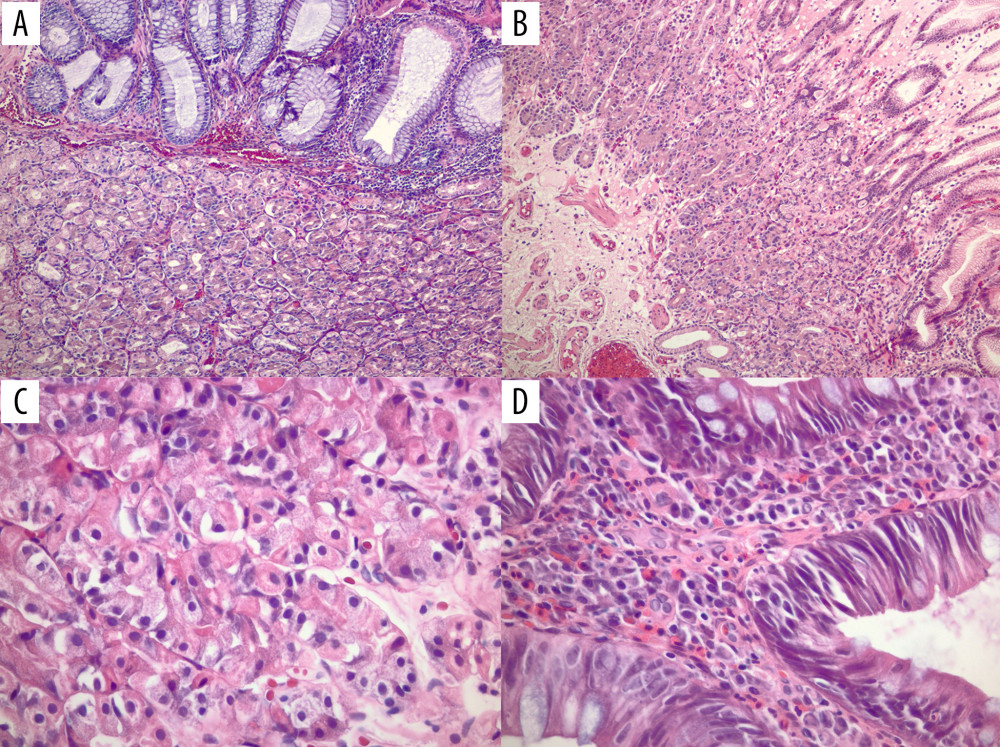Representative cases of mass-forming gastric heterotopia in the rectum. (A, B) Case 1 and 2 by H&E stain, respectively. Original magnification: 100×. (C) Case 1 on H&E stain highlighting gastric oxyntic mucosa (Original magnification: 400×). (D) Case 1 tubular adenoma with gastric heterotopic mucosa (Original magnification: 400×).